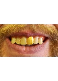 Золотой зуб светящийся